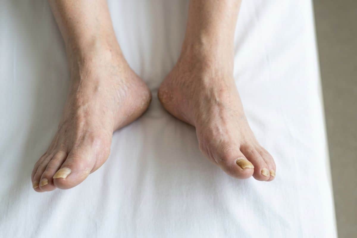 how to treat thickened toenails in diabetic patients