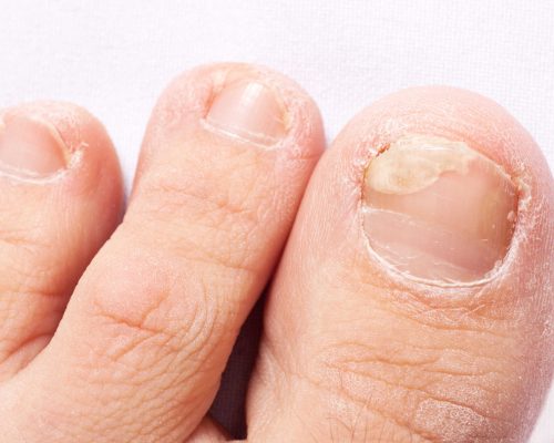 fungal nail infection (Onychomycosis). dry coarse skin of the legs (eczema)